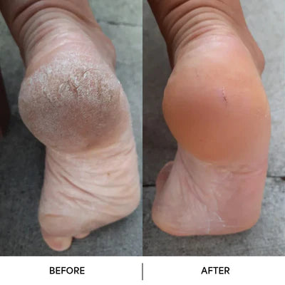 Luvelis Nuvia™ – Callus Remover for Radiant, Silky Feet