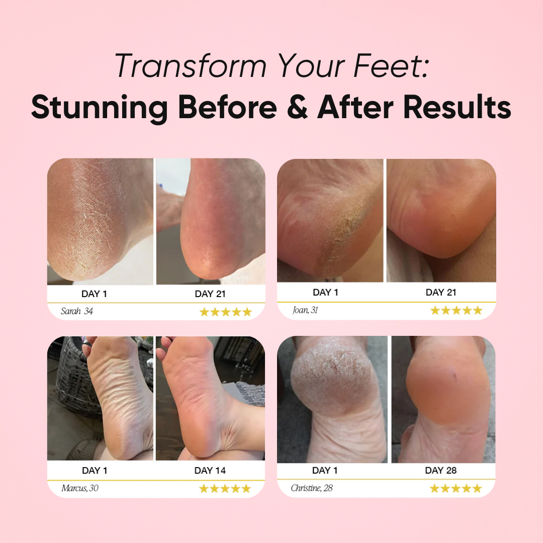 Luvelis Nuvia™ – Callus Remover for Radiant, Silky Feet